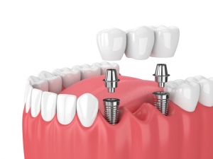 What Are the Benefits of Visiting the Montrose Dental Implant Office?